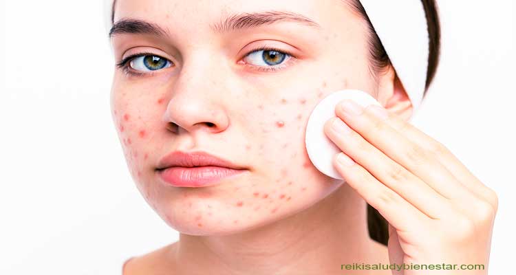 Causas Emocionales del Acné y Tratamiento Reiki